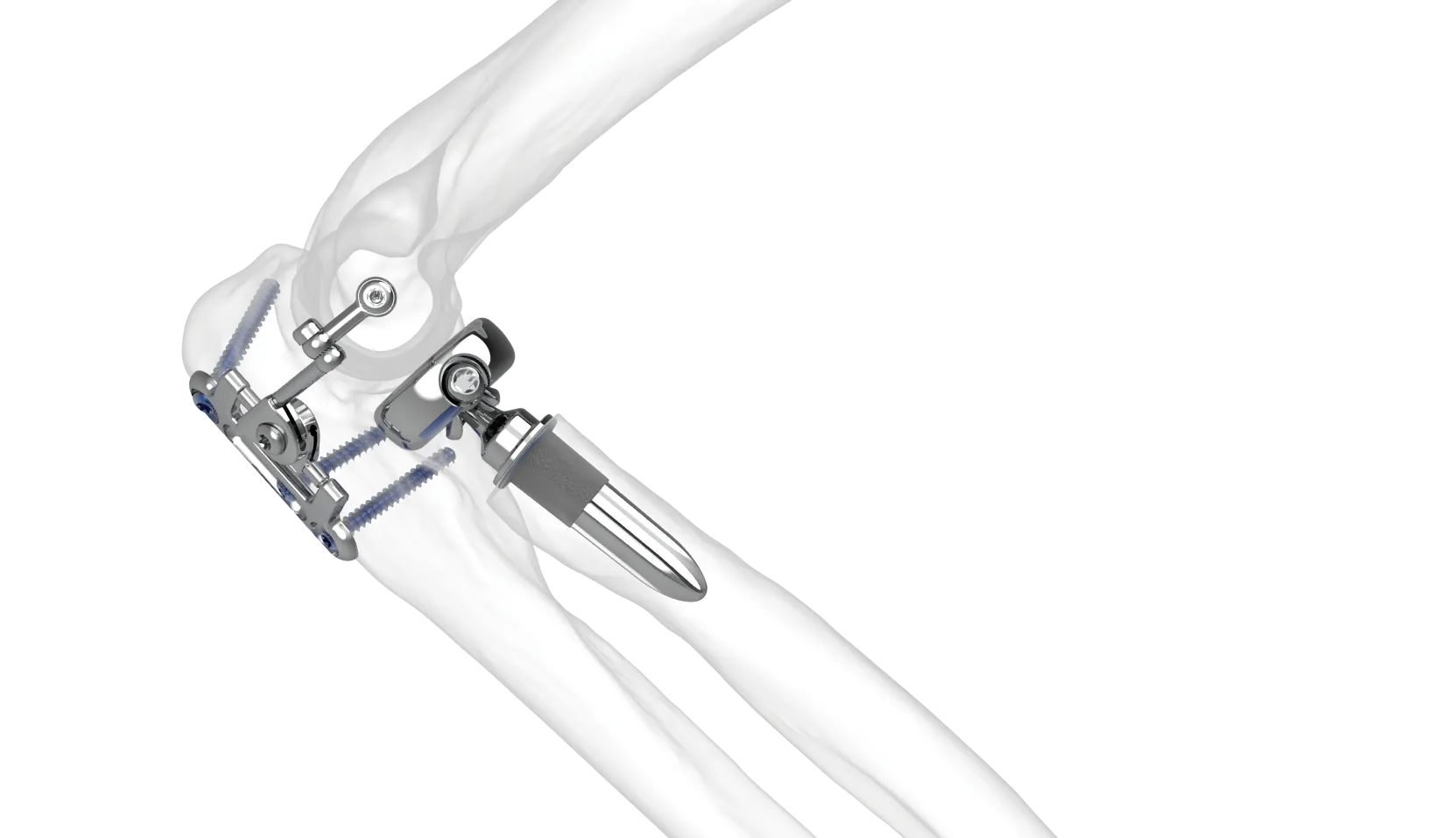 DES Distal Elbow Set