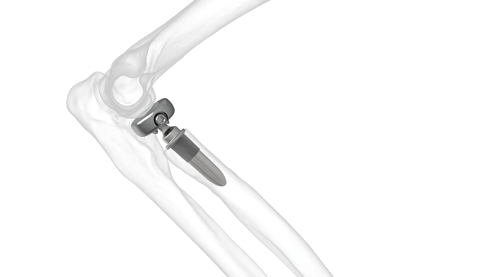 Align radial head replacement