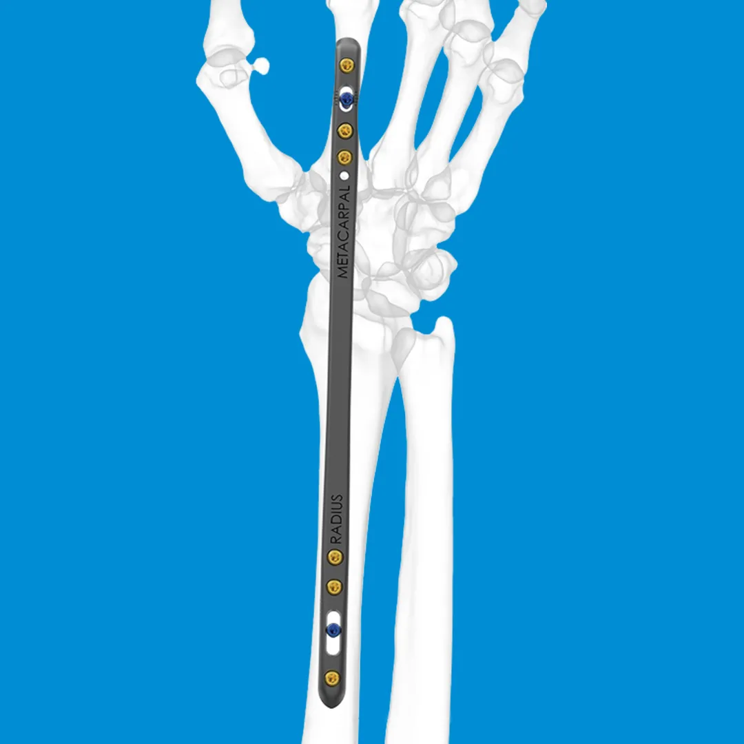 GEMINUS wrist plating