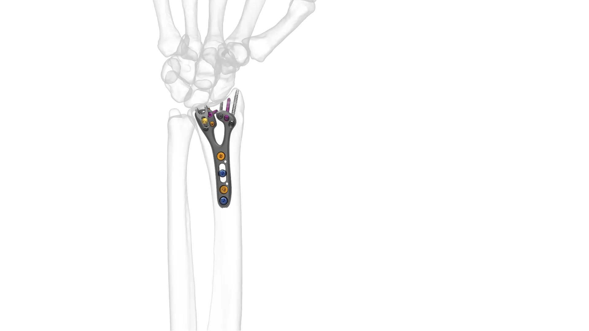 GEMINUS Distal Radius Volar Plate