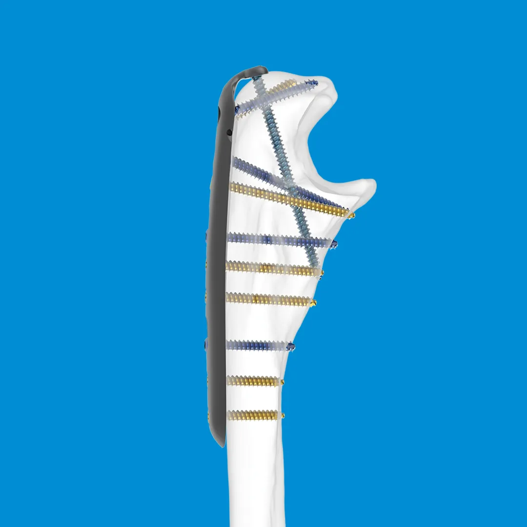 Proximal Ulna Plate