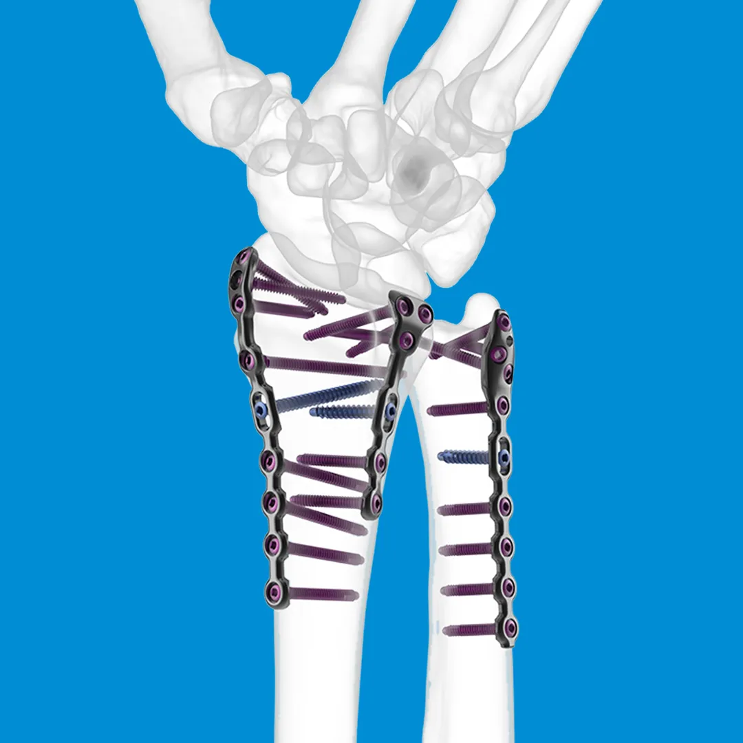 GEMINUS wrist plating