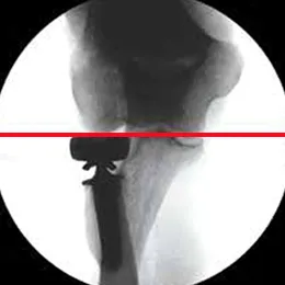 ALIGN Radial Head x-ray