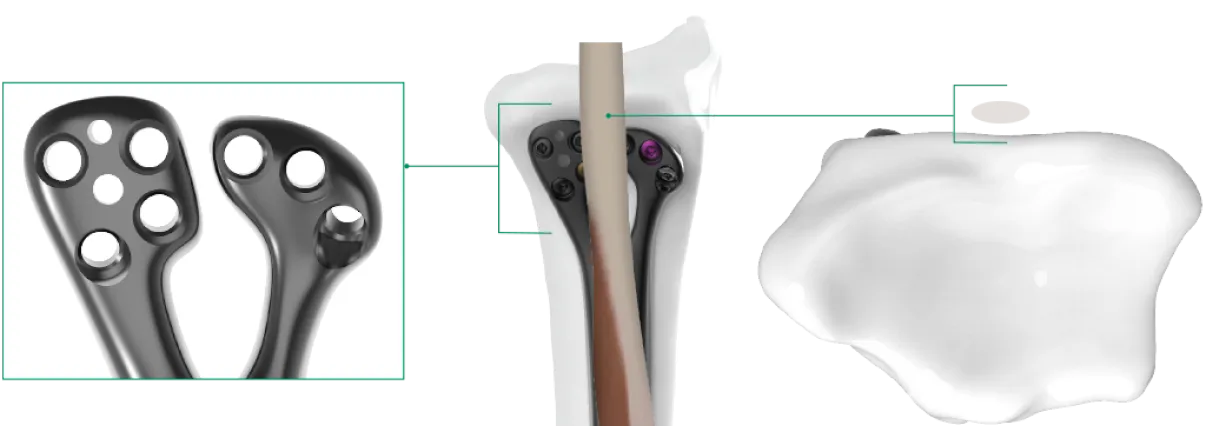 GEMINUS Distal Radius Volar Wrist Plating