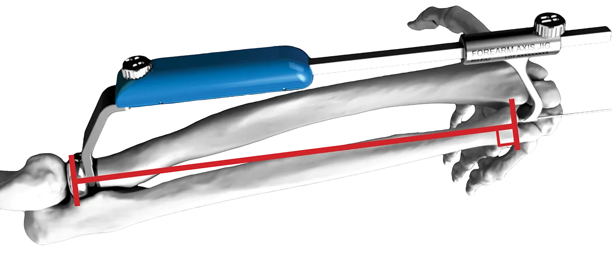 ALIGN® Radial Head system