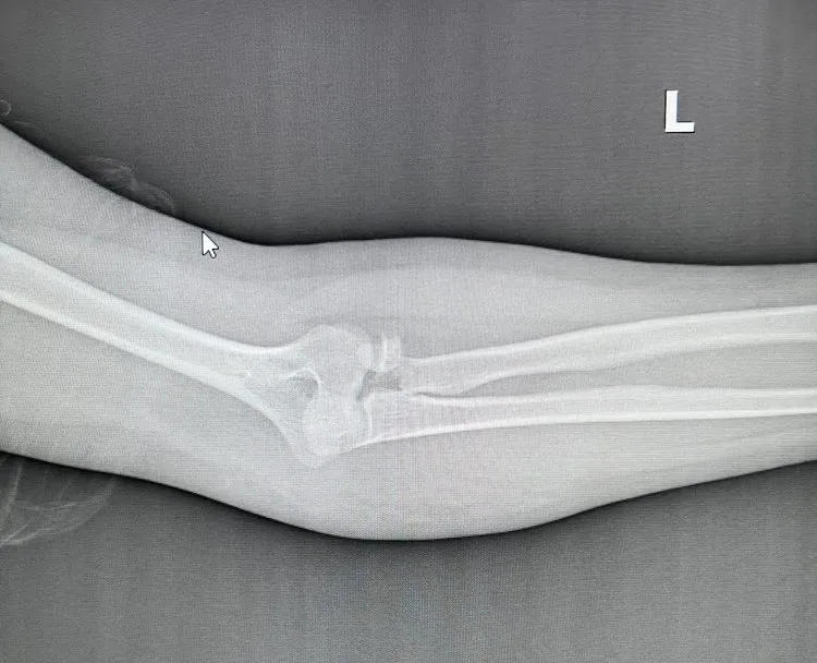 fractured arm