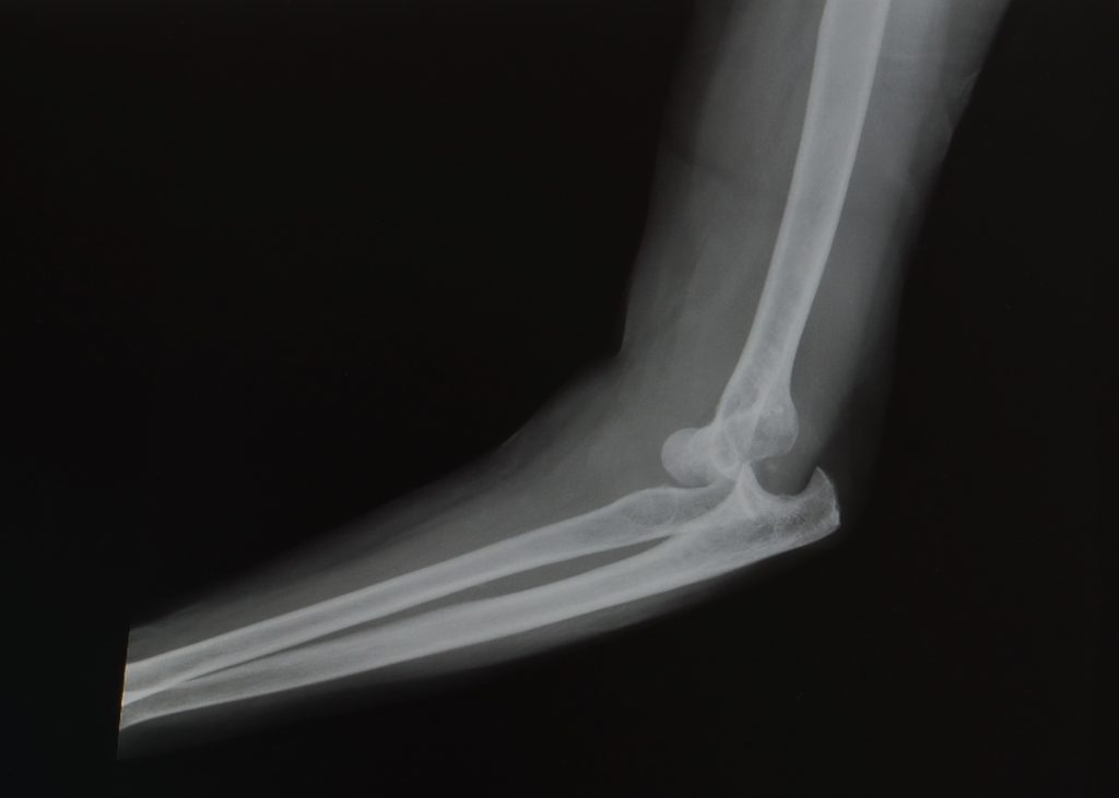 X ray showing severely dislocated elbow joint.