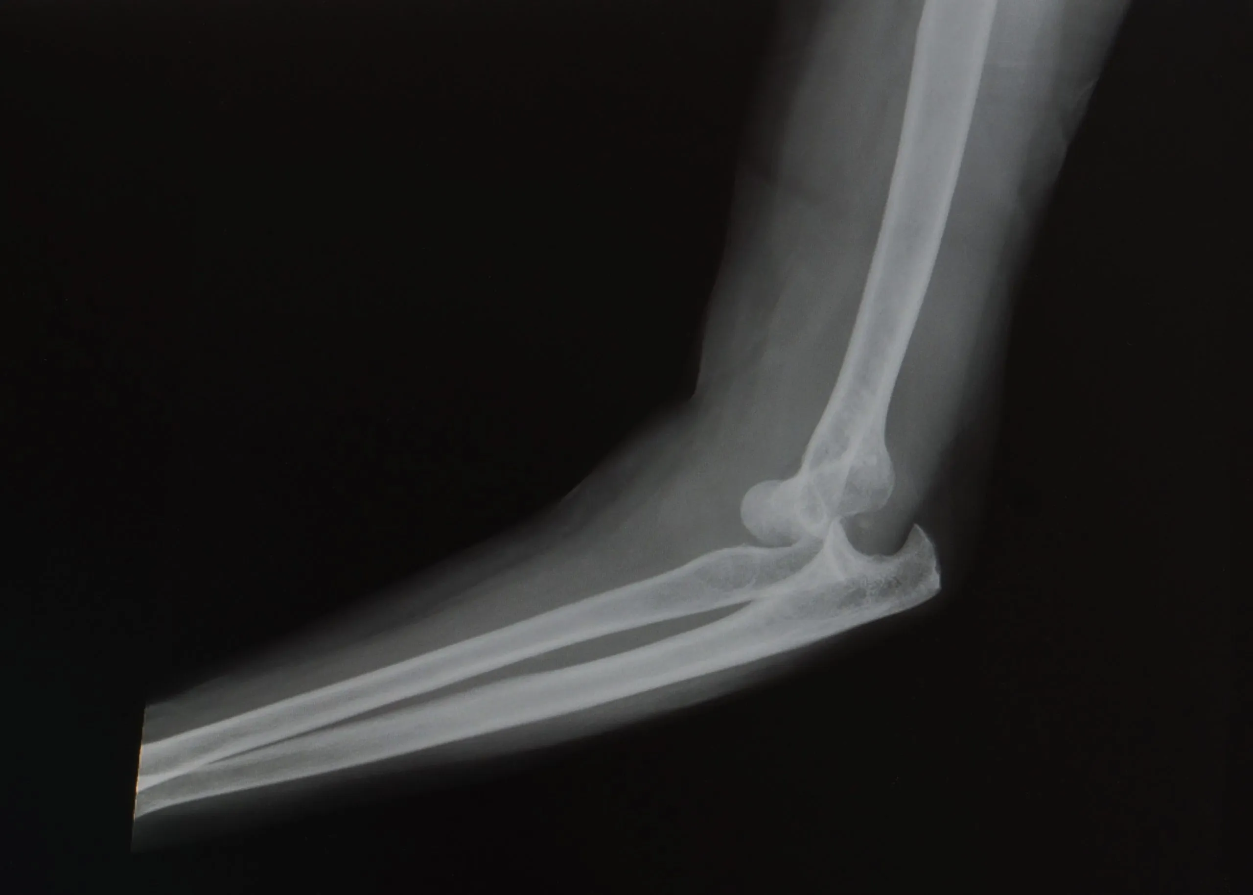 X ray showing severely dislocated elbow joint.