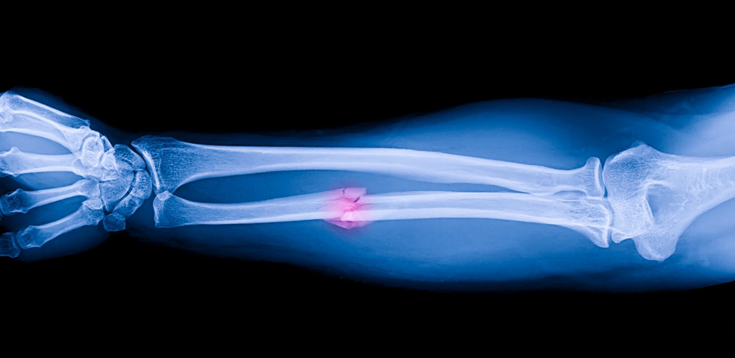 X-ray image showing a break in one of the bones in the middle of the forearm.