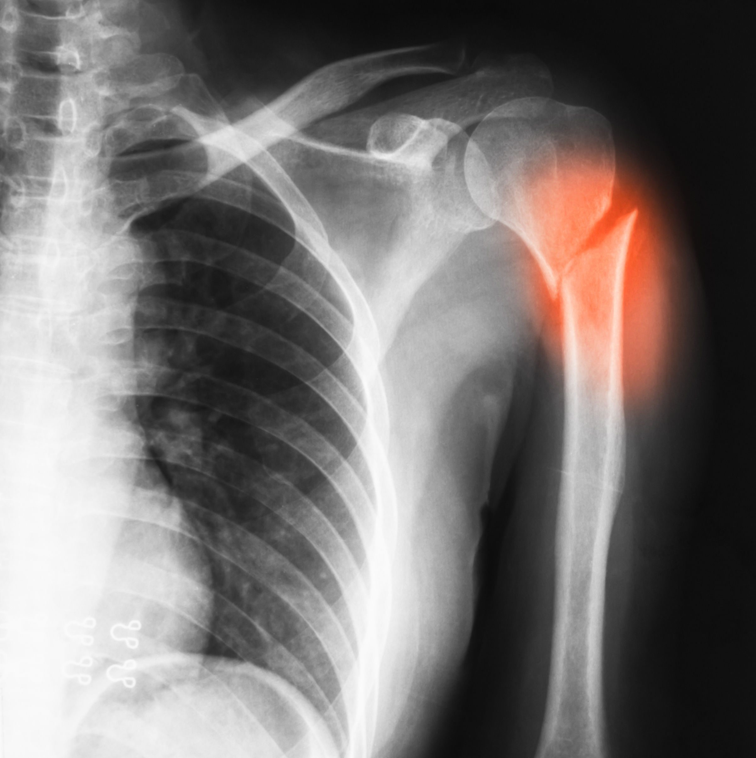 X-ray image showing a fracture in the arm bone near the shoulder joint.