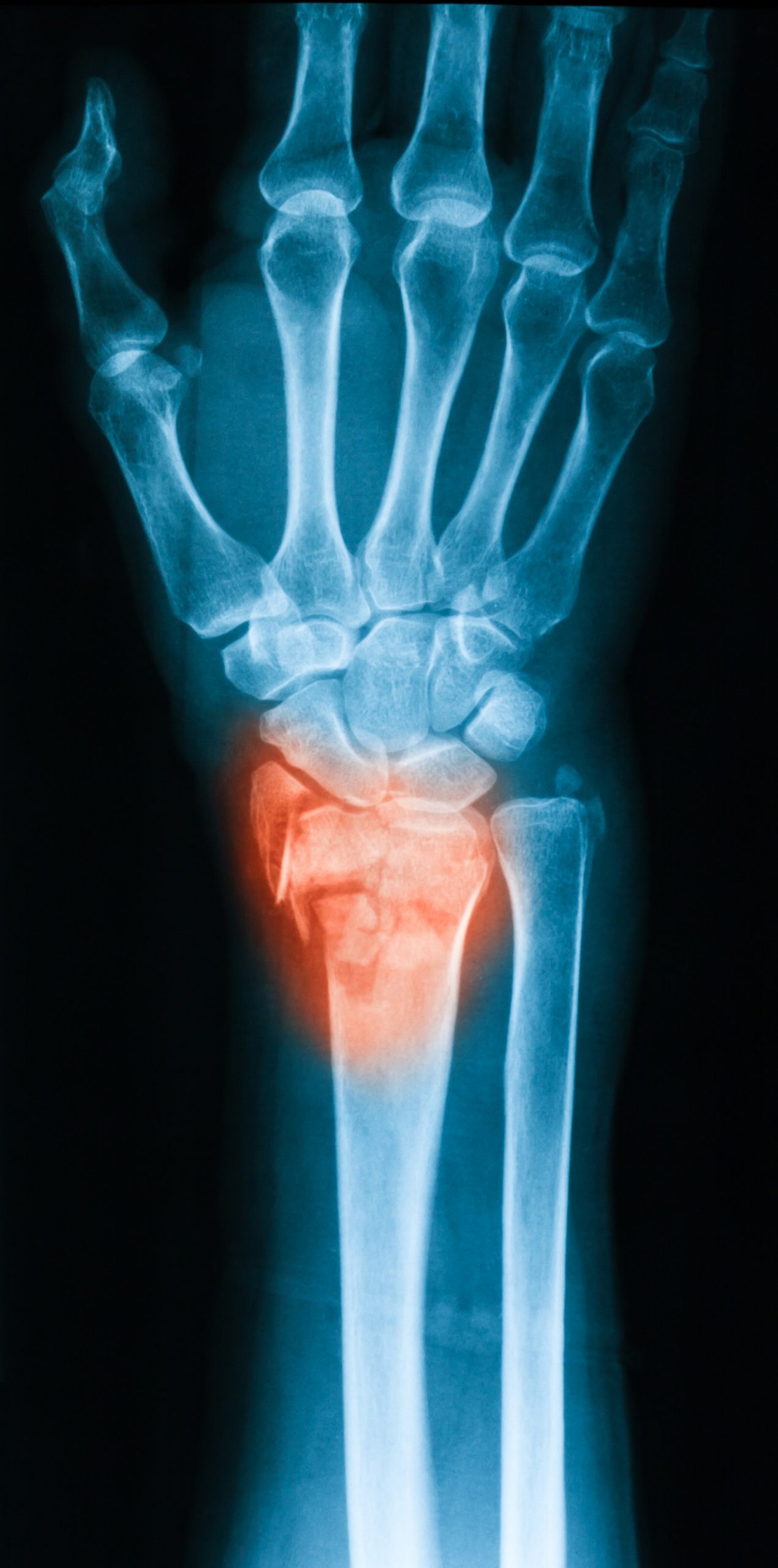 X-ray image of the wrist that shows bones coming into contact with each other.