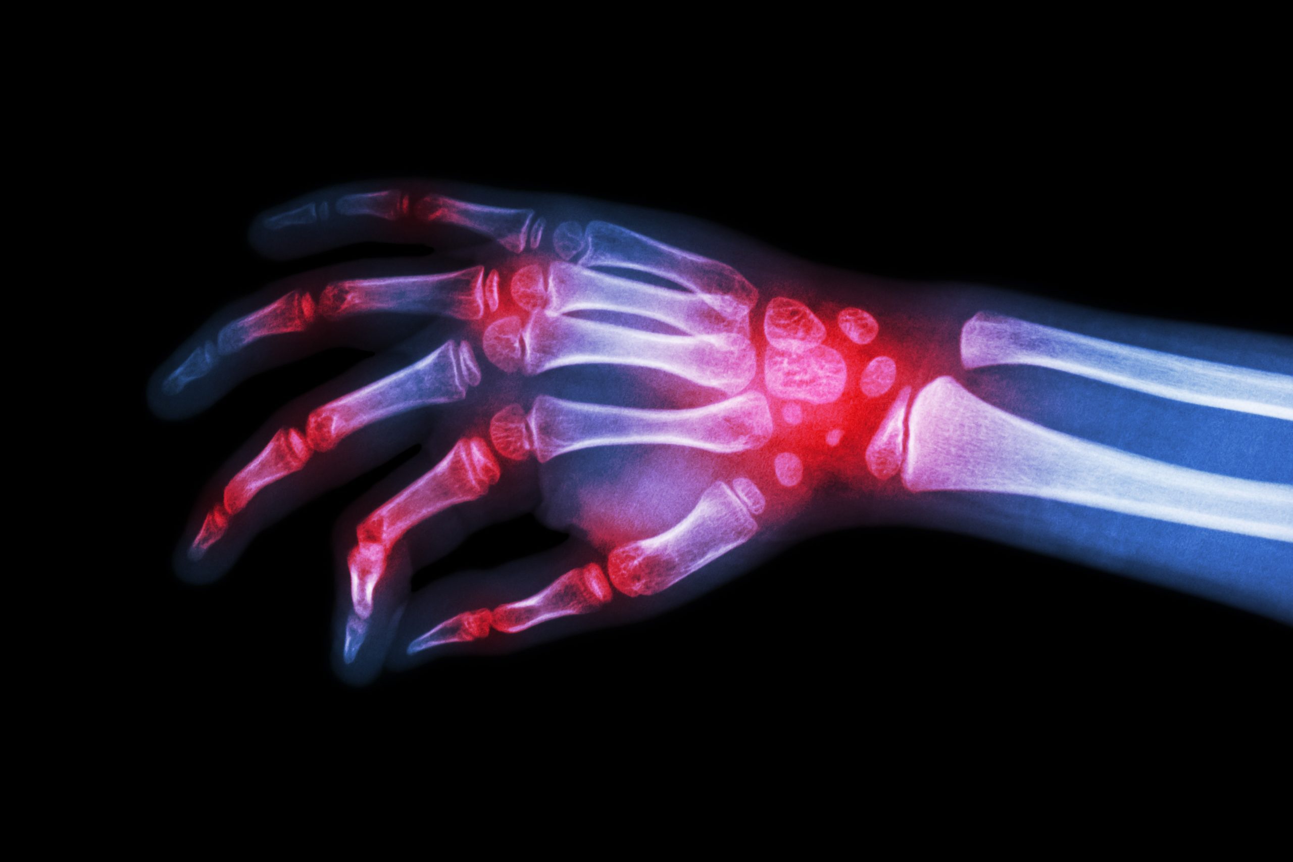 X-ray image showing damage to the wrist and multiple finger joints.