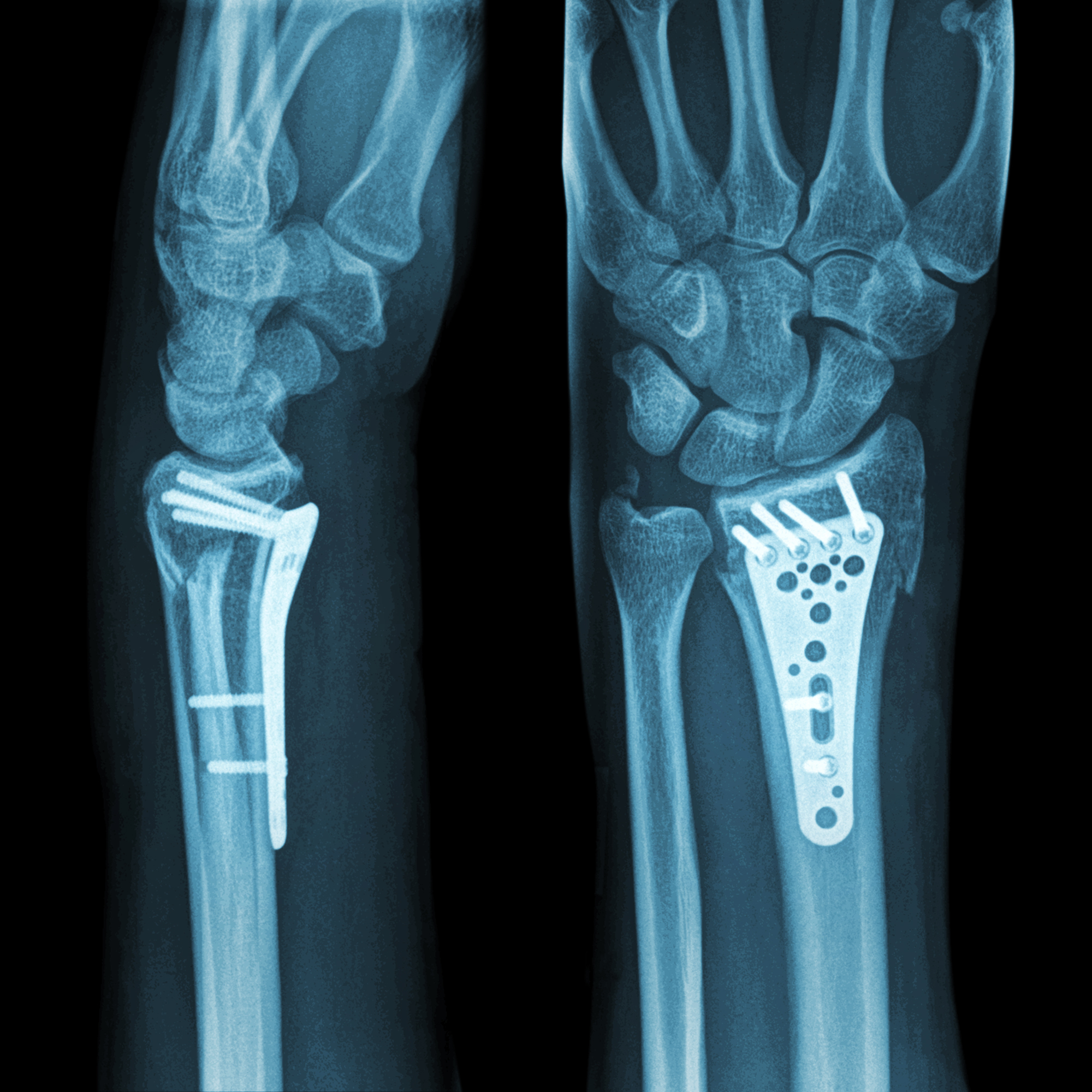 X-ray image showing an orthopaedic plate and screws at the distal radius.