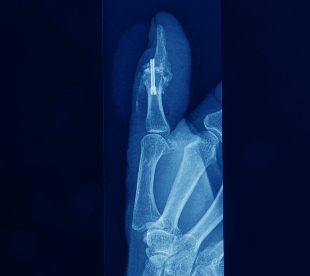 X-ray image showing a joint in the finger being fused using an orthopaedic nail implant.