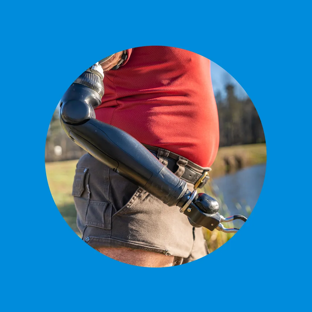 Integrum Osseointegration - arm prosthesis