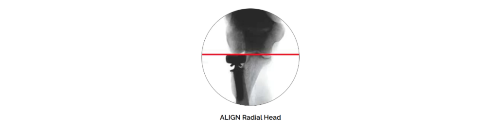 align radial head blog