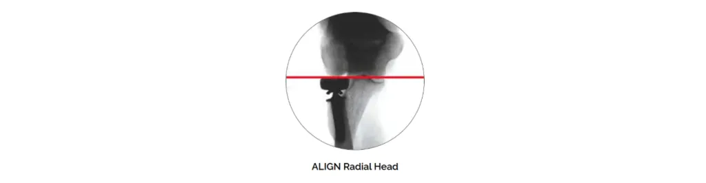 align radial head blog