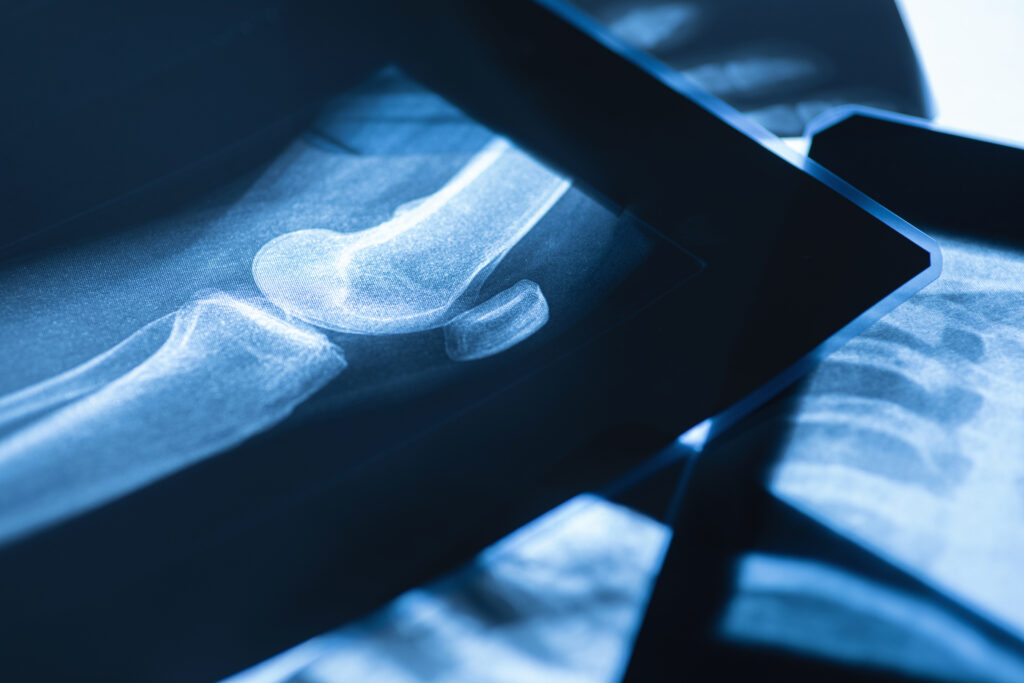 Key Differences Between Upper and Lower Limb Fracture Management